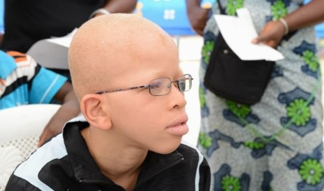 albinos en danger
